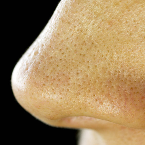 Are These Blackheads? Oftentimes, No.