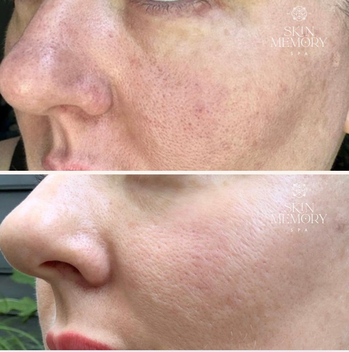 Our Most Transformative Treatment: The Elaine Brennan Skin Renewal Peel