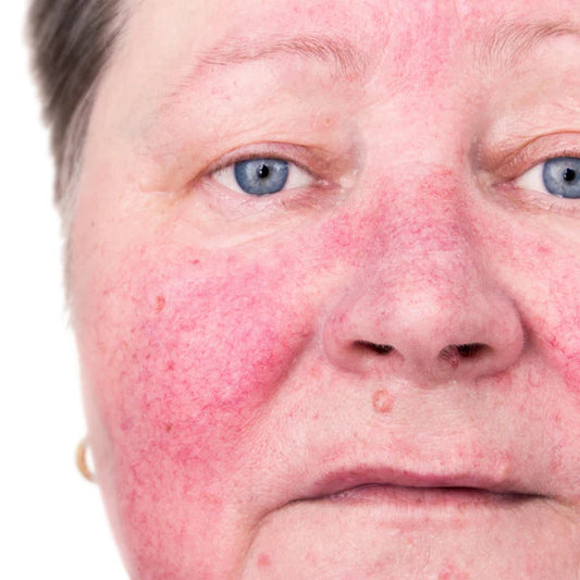 What is Rosacea?