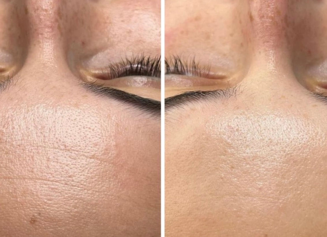 chemical peels in fairfax virginia