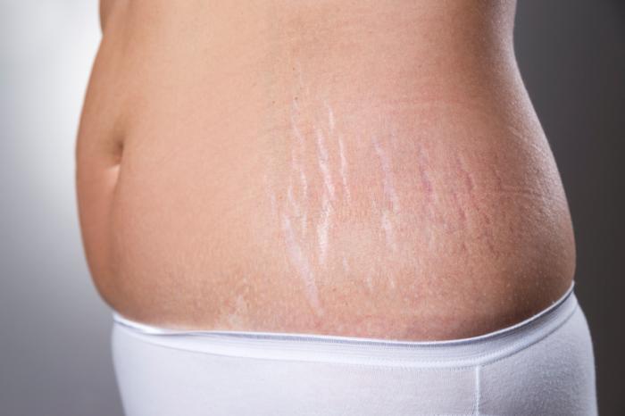 Stretch Mark Renewal Treatment