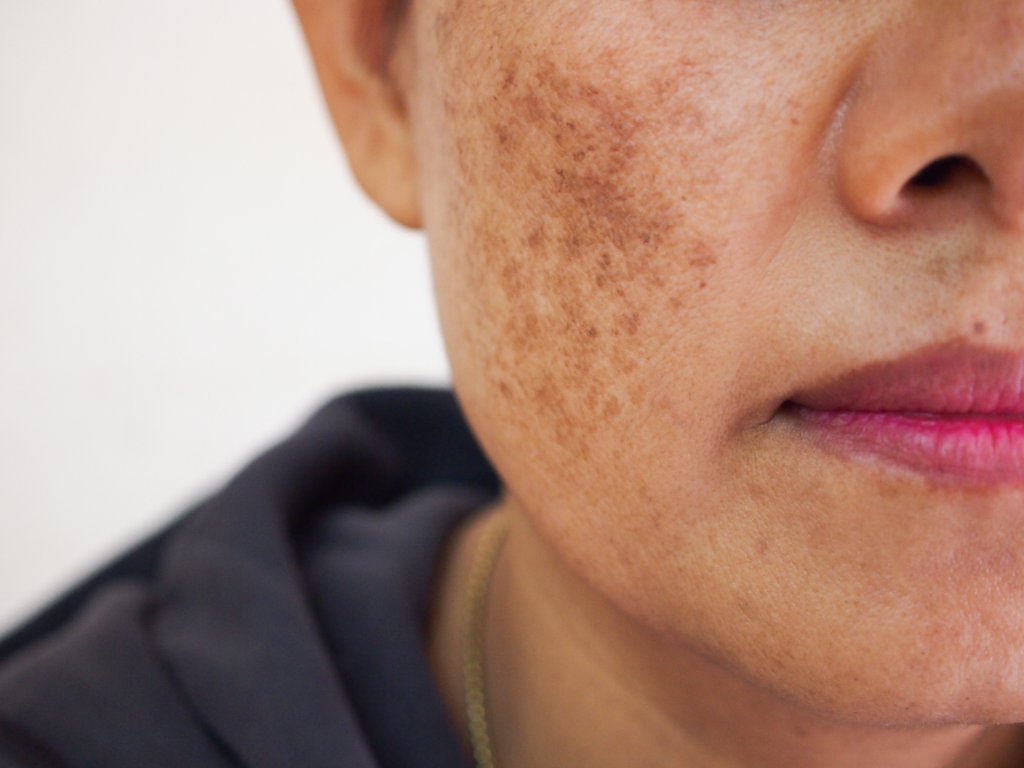 Managing Melasma