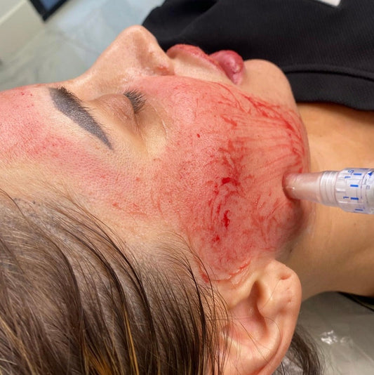 PRP Facials are Wasting Your Time and Money (aka the Vampire Facial)