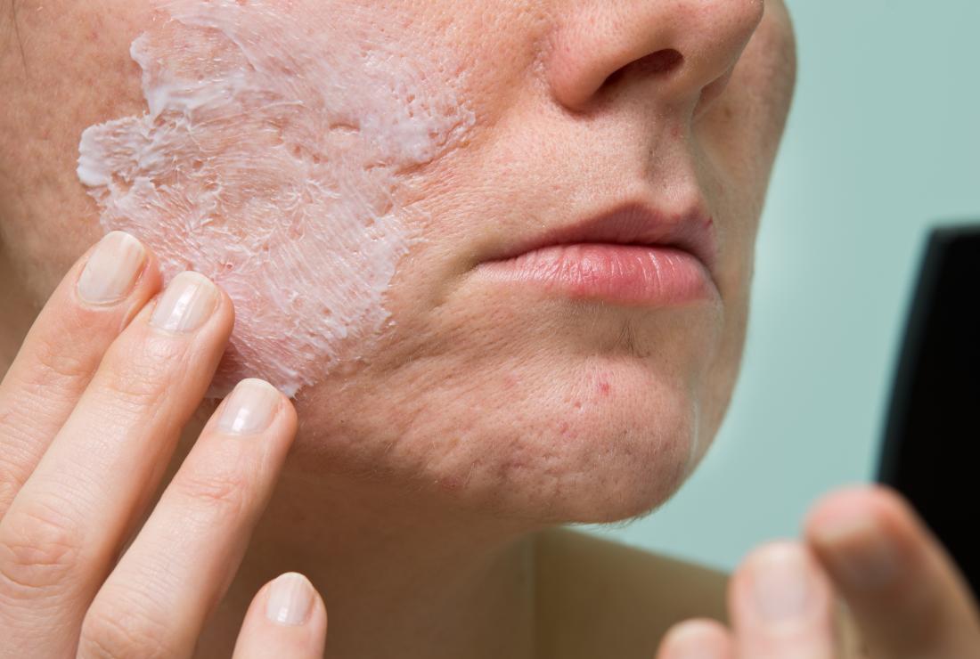 How Safe is Benzoyl Peroxide?