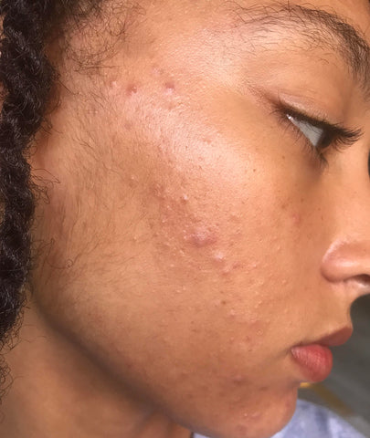 Do You Know the Causes of Acne? Probably Not!