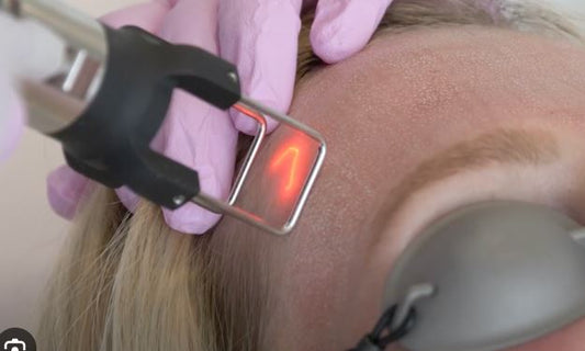 I Had a CO2 Cool Peel Laser. Was it Worth it?
