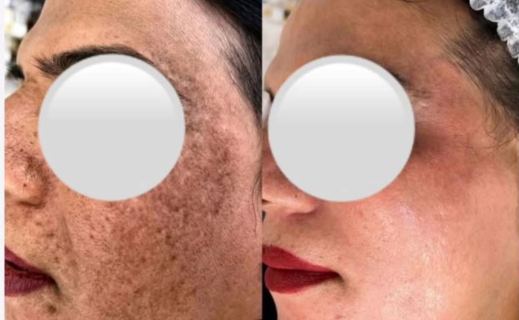 The Peel that Outperforms LASER!