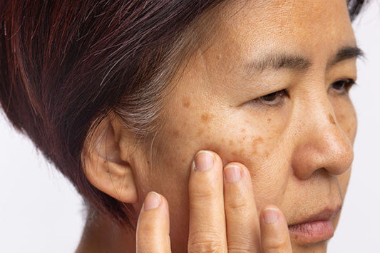 Managing Melasma During the Summer