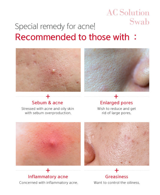 Acne Control Swabs