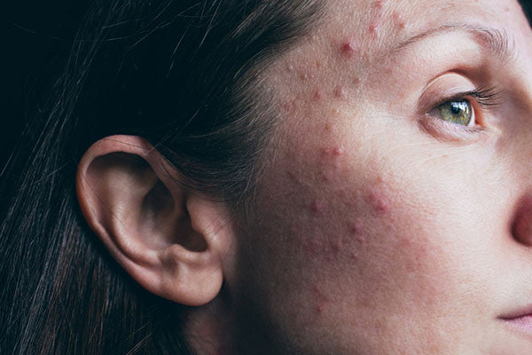 Acne Relief Treatment Package